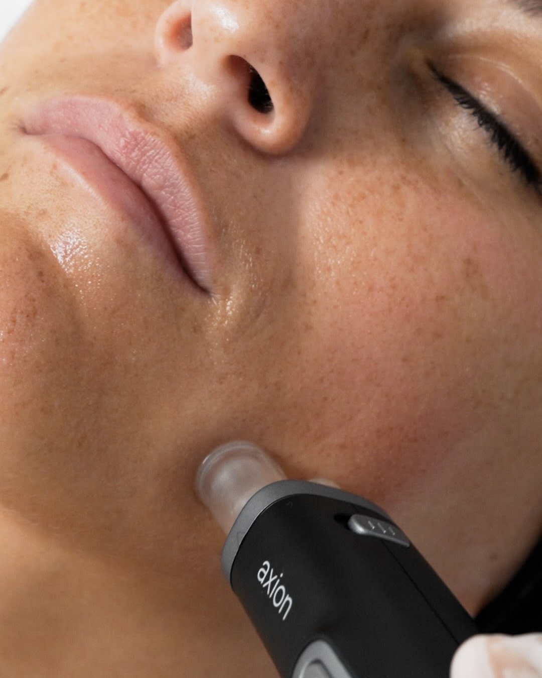Microneedling
